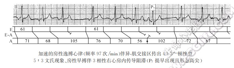 加速的房性逸搏心律