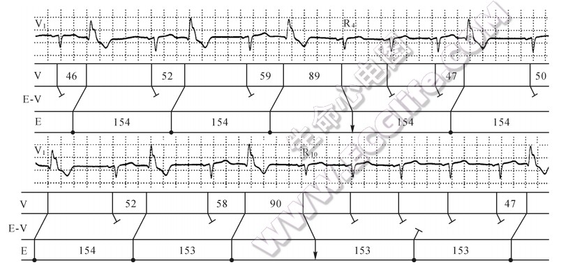 间歇性并行心律的心电图表现