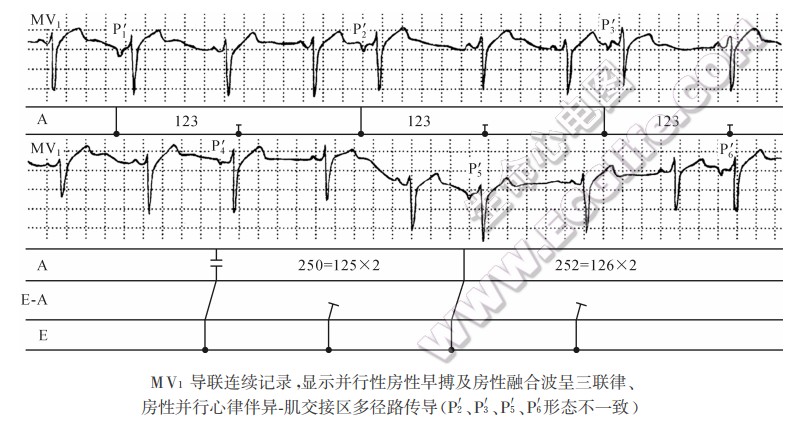 MV1导联连续记录，显示并行性房性早搏及房性融合波呈三联律、房性并行心律伴异．肌交接区多径路传导（P2'、P3'、P5'、P6'形态不一致）