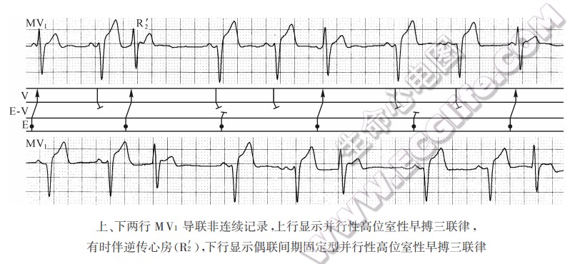 上、下两行MV1导联非连续记录，上行显示并行性高位室性早搏三联律，有时伴逆传心房（R2'），下行显示偶联间期固定型并行性高位室性早搏三联律（心电图）