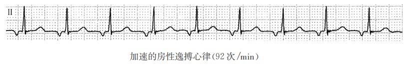 加速的房性逸搏心律