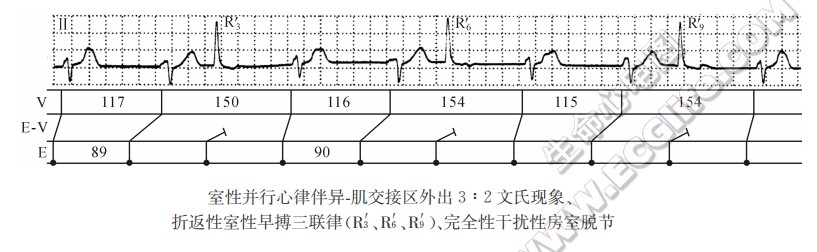 室性并行心律伴异．肌交接区外出3:2文氏现象、折返性室性早搏三联律（R3'、R6'、R9'）、完全性干扰性房室脱节（心电图）