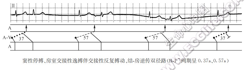 窦性停搏、房室交接性逸搏伴交接性反复搏动、结-房逆传双径路（心电图）