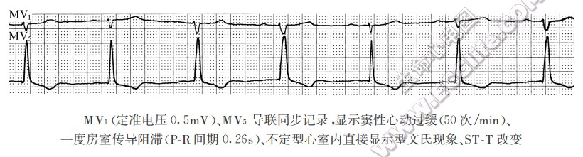 不定型心室内直接显示型文氏现象（心电图）