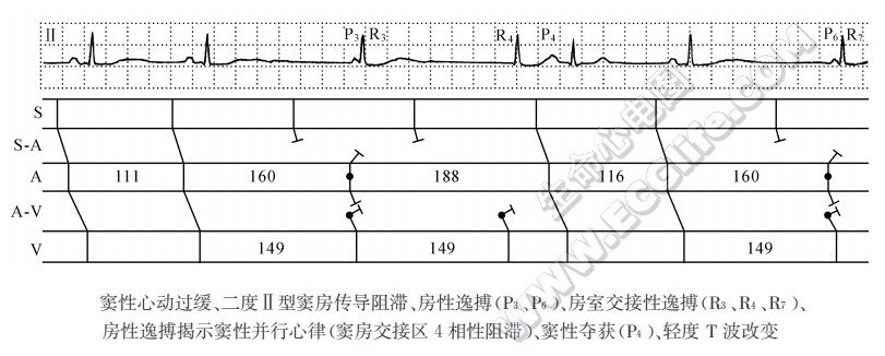 窦房结周围或窦房交接区4相阻滞（心电图）