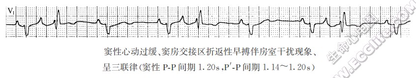 窦房交接性早搏(心电图)