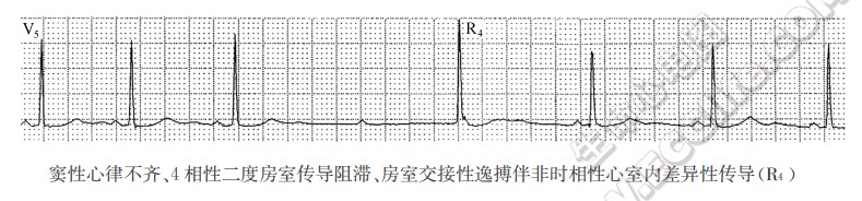 窦性心律不齐、4相性二度房室传导阻滞、房室交接性逸搏伴非时相性心室内差异性传导（心电图）