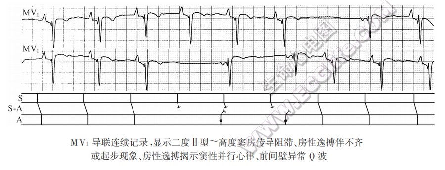 房性逸搏揭示窦性并行心律（心电图）