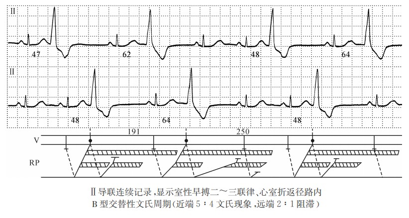 Ⅱ导联连续记录，显示室性早搏二～三联律、心室折返径路内B型交替性文氏周期（心电图）