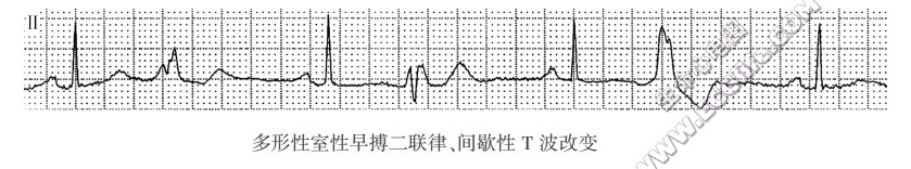 多形性室性早搏二联律、间歇性T波改变（心电图）