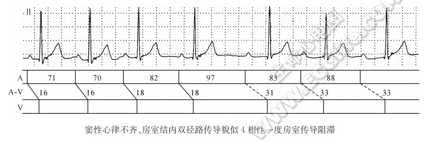 窦性心律不齐、房室结内双径路传导貌似4相性一度房室传导阻滞