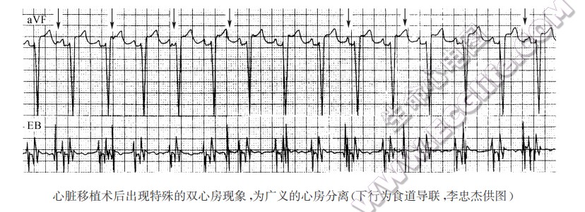 心脏移植术后出现特殊的双心房现象，为广义的心房分离cT行为食道导联，李忠杰供图）（心电图）