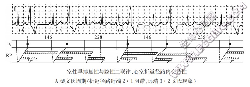 偶联间期递增型室性早搏（心电图）