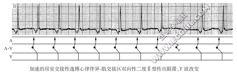 加速的房室交接性逸搏心律伴异-肌交接区双向性二度Ⅱ型传出阻滞、T波改变