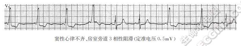 窦性心律不齐、房室旁道3相性阻滞(定准电压0.5mV)（心电图）
