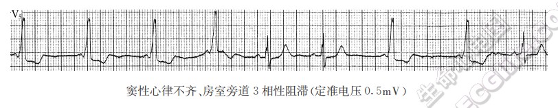 窦性心律不齐、房室旁道3相性阻滞(定准电压0.5mV)（心电图）