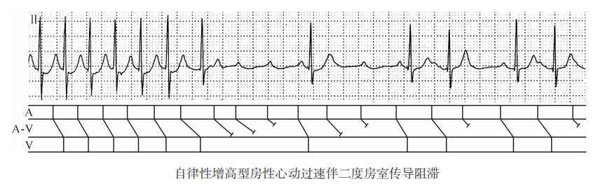 自律性增高型房性心动过速伴二度房室传导阻滞（心电图）