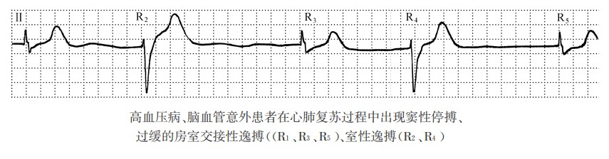 室性逸搏和逸搏心律