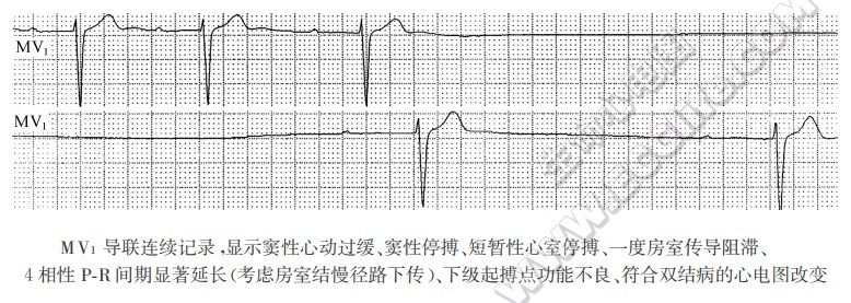 MV1导联连续记录，显示窦性心动过缓、窦性停搏、短暂性心室停搏、一度房室传导阻滞、4相性P-R间期显著延长（考虑房室结慢径路下传）、下级起搏点功能不良、符合双结病的心电图改变（心电图）
