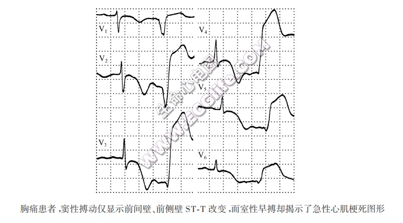 胸痛患者，窦性搏动仅显示前间壁、前侧壁ST-T改变，而窒性早搏却揭示了急性心肌梗死图形（心电图）