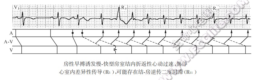 慢一快型房室结内折返性心动过速（心电图）