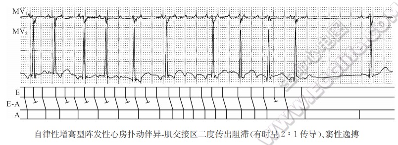 自律性增高型阵发性心房扑动伴异-肌交接区二度传小阻滞（有时呈2：1传导）、窦性逸搏