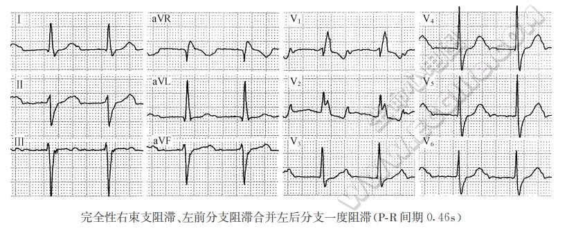 三支传导阻滞