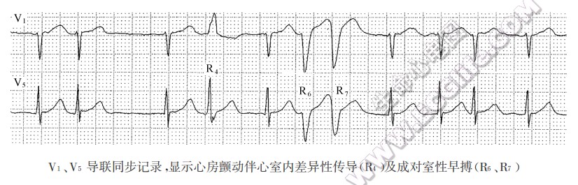 V1、V5导联同步记录，显示心房颤动伴心室内差异性传导（R4）及成对室性早搏(R6、R7)（心电图）