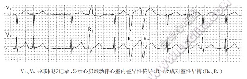 心室颤动的发生机制、分类及临床意义