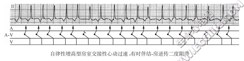 自律性增高型房室交接性心动过速，有时伴结一房逆传二度阻滞（心电图）