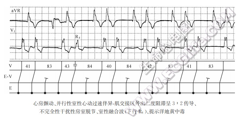 心房颤动、并行性室性心动过速伴异一肌交接区外出二度阻滞呈3:2传导、不完全性干扰性房室脱节、室性融合渡（下行融）、提示洋地黄中毒（心电图）