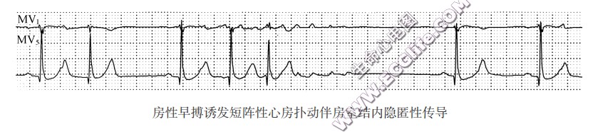 房性早搏诱发短降陛心房扑动伴房室结内隐匿性传导（心电图）