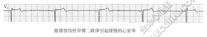 阻滞型房性早搏二联律引起缓慢的心室率(心电图)