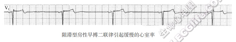 心房内折返性心律失常