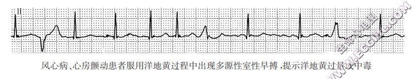 风心病、心房颤动患者服用洋地黄过程中出现多源性室性早搏，提示洋地黄过量或中毒（心电图）