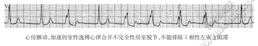 心房颤动、加速的室性逸搏心律合并不完全性房室脱节、不能排除3相性左柬支阻滞（心电图）