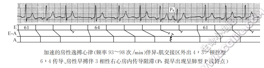 加速的房性逸搏心律（心电图）