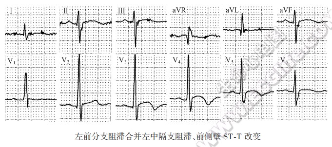 前间壁出现交替性异常Q波，提示交替性I型左中隔支阻滞（心电图）