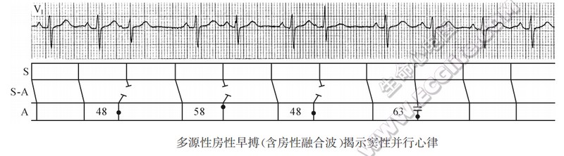 房性早搏揭示窦性并行心律（心电图）