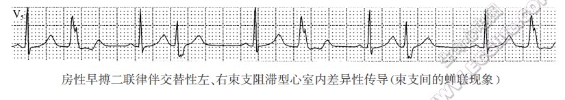 房性早搏二联律伴交替性左、右柬支阻滞型心室内差异性传导（柬支间的蝉联现象）