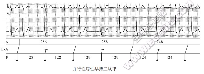 并行性房性早搏三联律（心电图）