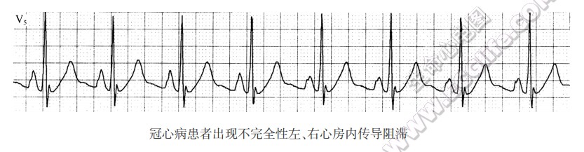 冠jb病患者出现不完全性左、右心房内传导阻滞（心电图）