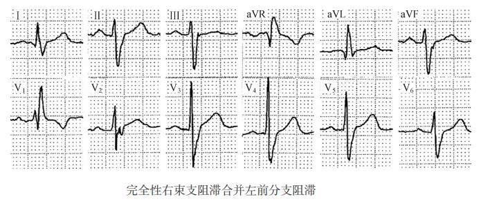 完全性右束支阻滞合并左前分支阻滞（心电图）
