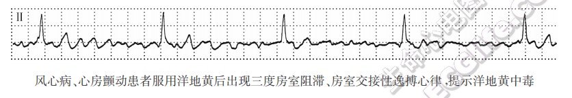 风心病、心房颤动患者服用洋地黄后出现三度房室阻滞、房室交接性逸搏心律，提示洋地黄中毒（心电图）