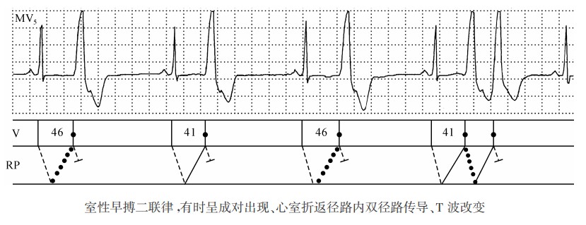 室性早搏二联律，有时呈成对出现、心室折返径路内双径路传导、T波改变（心电图）