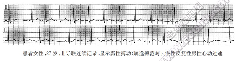 患者女性，27岁，Ⅱ导联连续记录，显示窦性搏动（属逸搏范畴）、慢性反复性房性心动过速（心电图）