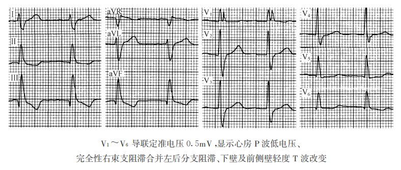 右束支阻滞合并左后分支阻滞