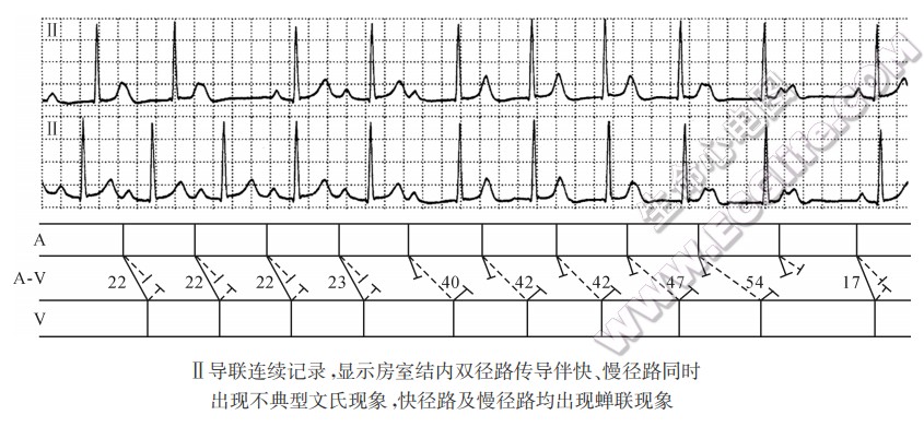 Ⅱ导联连续记录，显示房室结内双径路传导伴快、慢径路同时出现不典型文氏现象，快径路及慢径路均出现蝉联现象（心电图）