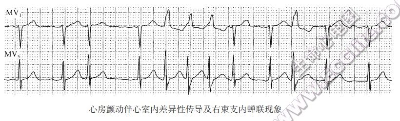 心房颤动伴心室内差异性传导及右束支内蝉联现象（心电图）