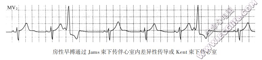 房性早搏伴旁道下传